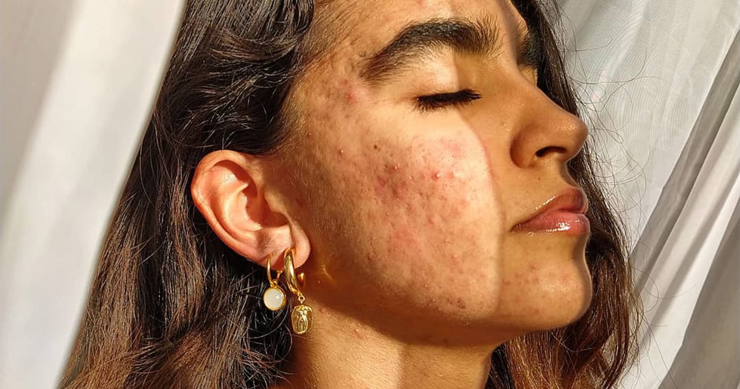 Life After Roaccutane: What To Do When Acne's Last Resort Doesn't Work