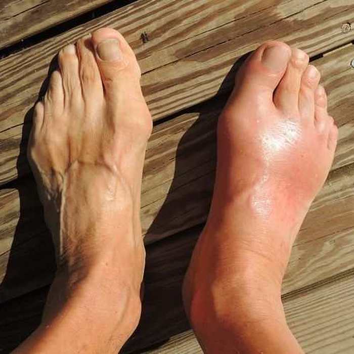 Herbal Gout Treatment: Natural Remedies for Gout Pain Relief
