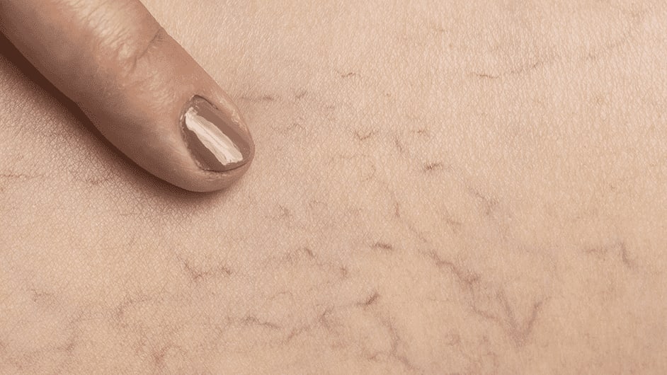 What You Need To Know About Fibromyalgia Spider Veins