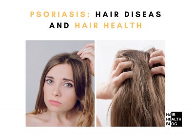Psoriasis: Hair Diseas And Hair Health