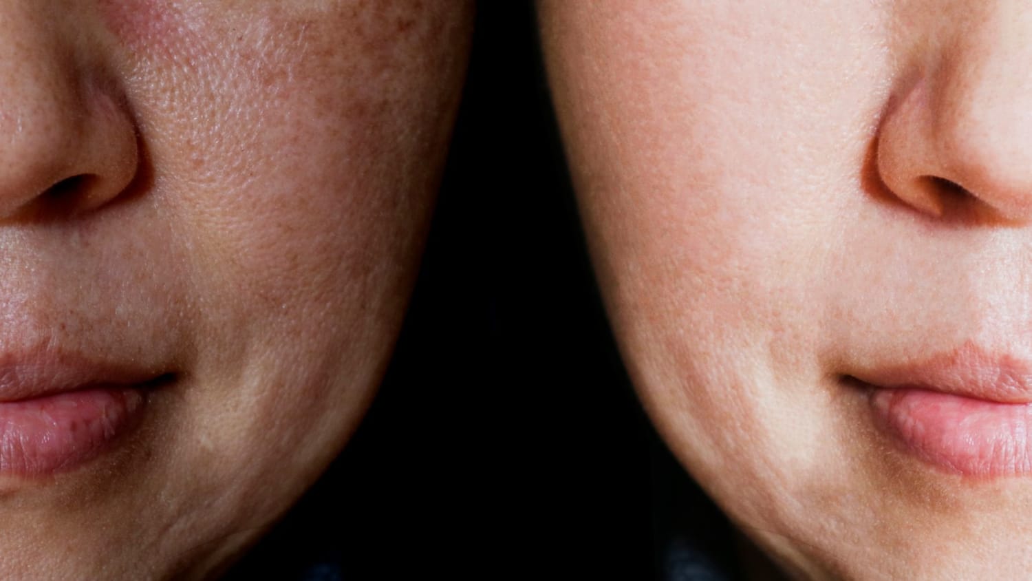 This Skin Condition Affects Nearly 5 Million Americans And The Sun Makes It Worse
