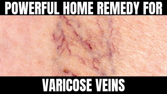 How To Get Rid Of Varicose Veins Fast - Skin Care Tips