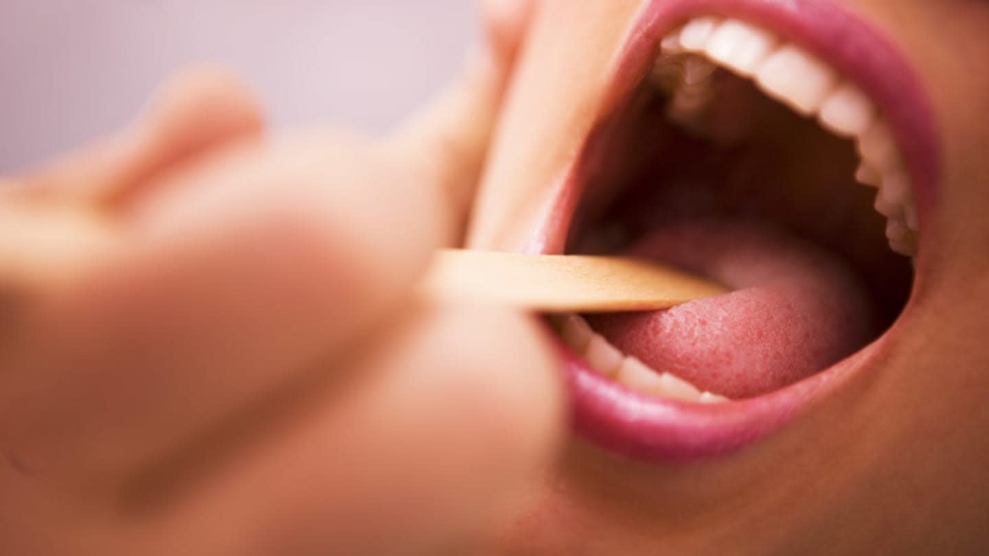 What Are Tonsil Stones?