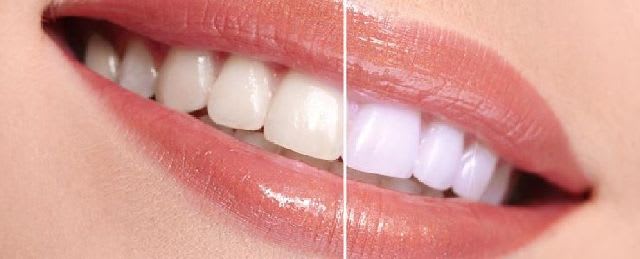 Teeth Whitening in snellville