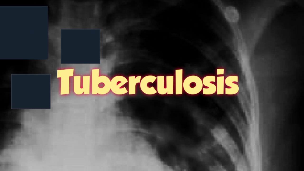 Tuberculosis: Causes, Prevention and Essential info
