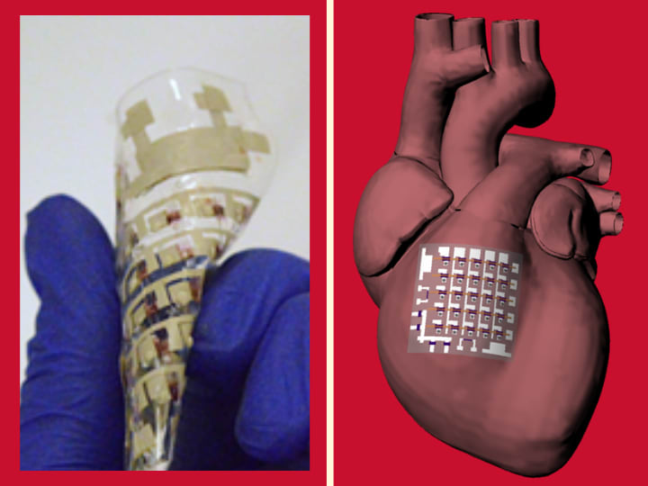 Implantable Device Can Monitor and Treat Heart Disease