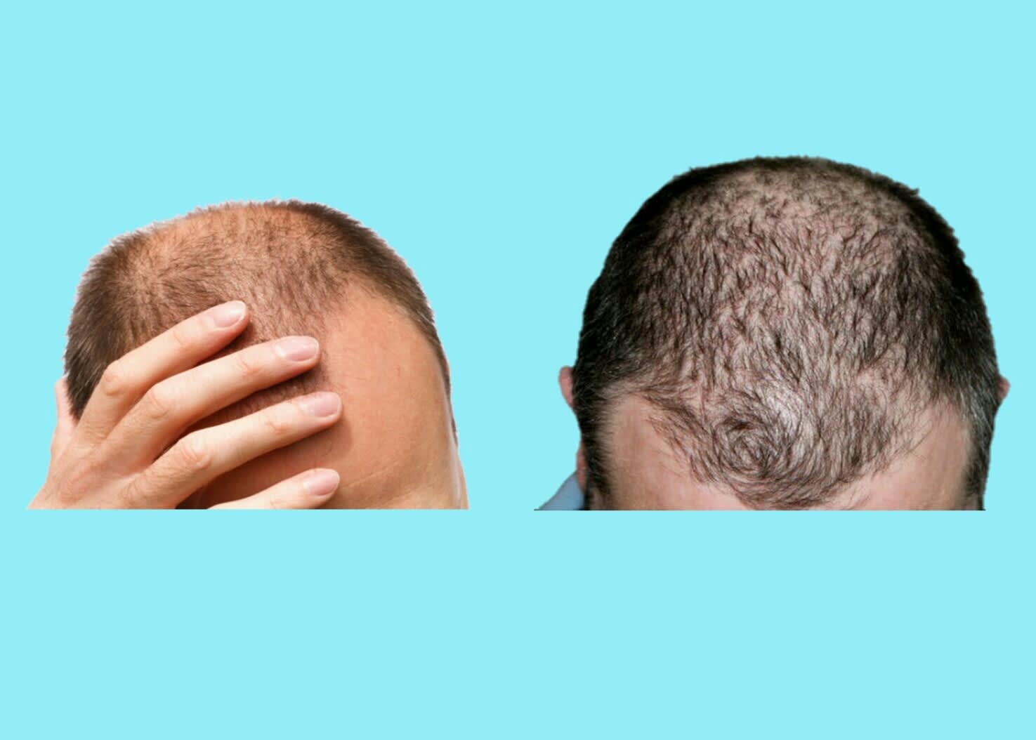 Easy remedy to remove baldness
