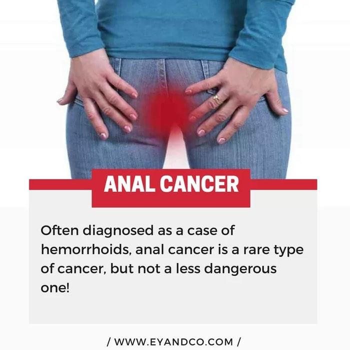 6 signs of anal cancer that everyone is embarrassed to talk about! - Mind & Health