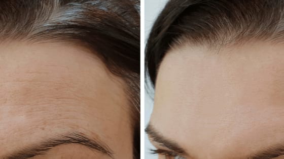 How To Get Rid Of Wrinkles On Forehead - Skin Care Tips