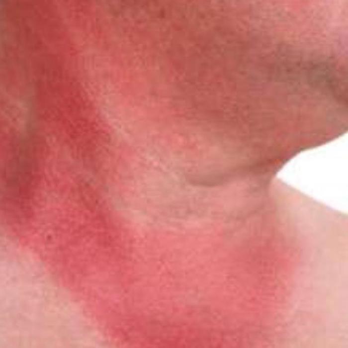 Prevention and rapid cure for sunburn | Way To Health