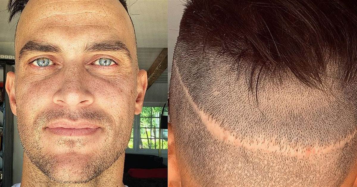 Actor reveals he's had 5 hair transplant surgeries, shows off scar