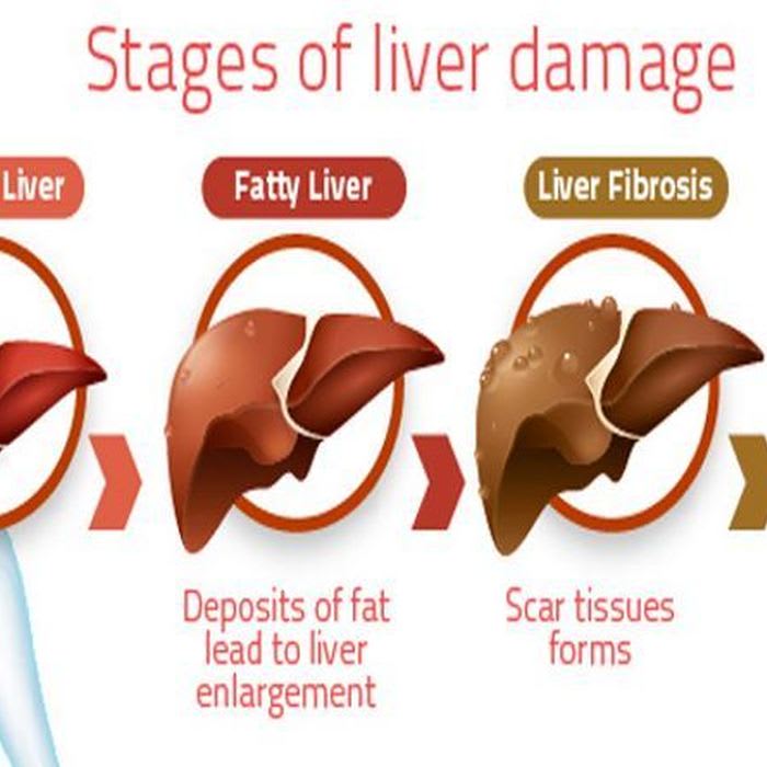 These 6 Surprising Things Can Damage Your Liver - Page 2 of 2