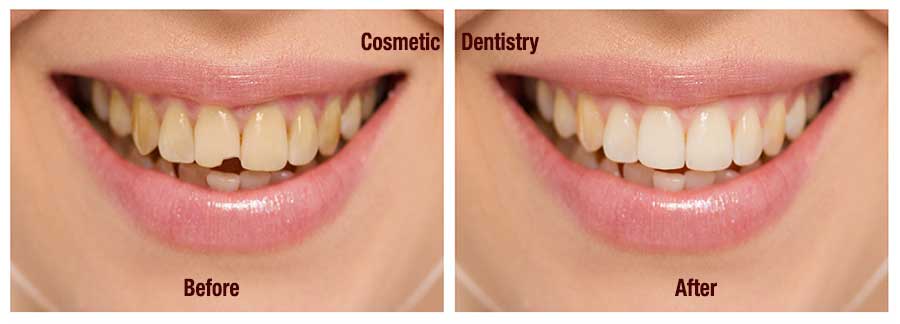Cosmetic Dentistry in Barsha, Dubai - All Smiles Dental Spa