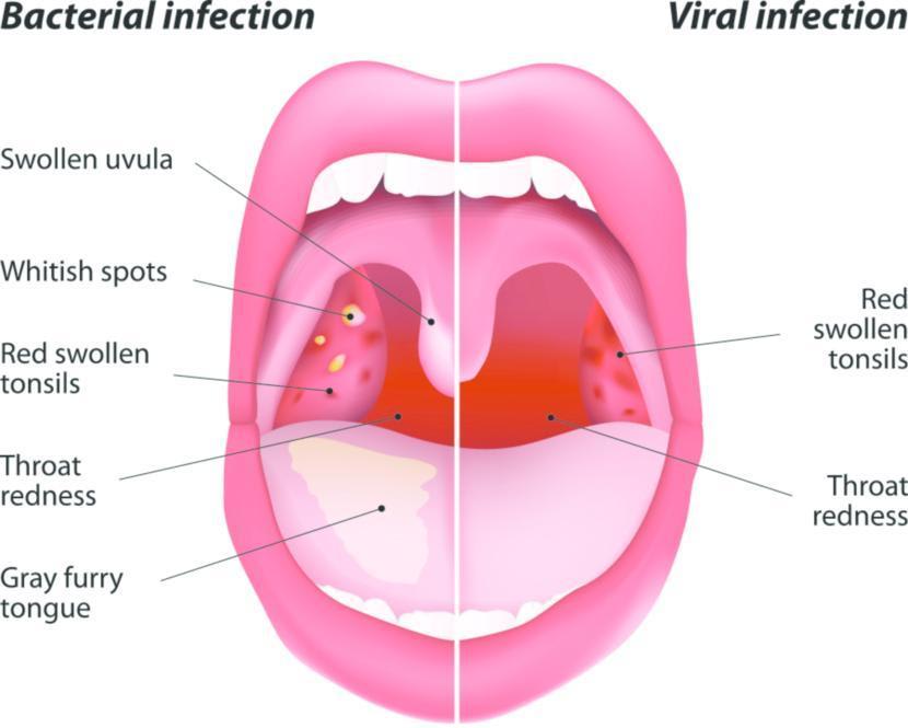 Can you get Strep Throat Without tonsils? | Strep tonsilities