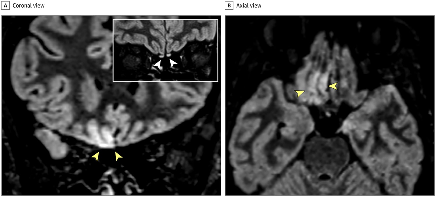 Magnetic Resonance Imaging Alteration of the Brain in a Patient With COVID-19 and Anosmia