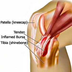 Inside (Medial) Knee Pain: Symptoms & Treatment Plan - Your Health Guideline