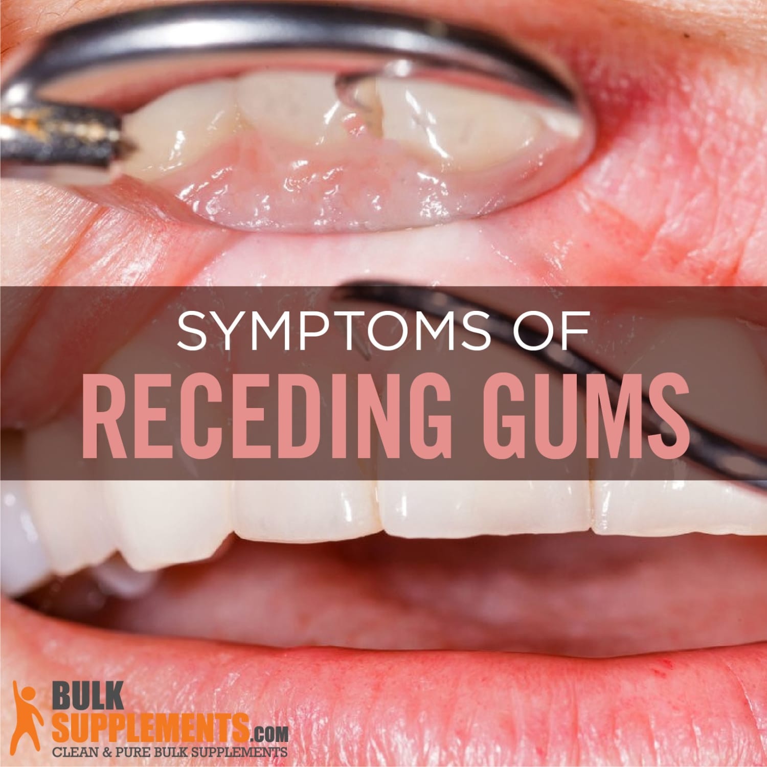 Receding Gums: Symptoms, Causes & Treatment