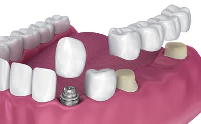Cosmetic Dental Crowns Caringbah, Dental Crown, Tooth Bridge Caringbah
