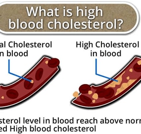 What is high blood cholesterol? | CircleCare