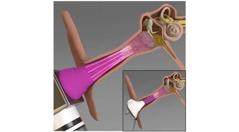 Researchers develop a new technique to treat middle ear infections
