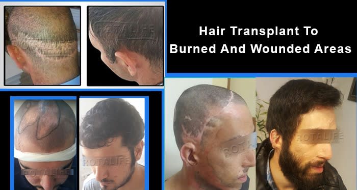 Hair Transplant To Burned And Wounded Areas