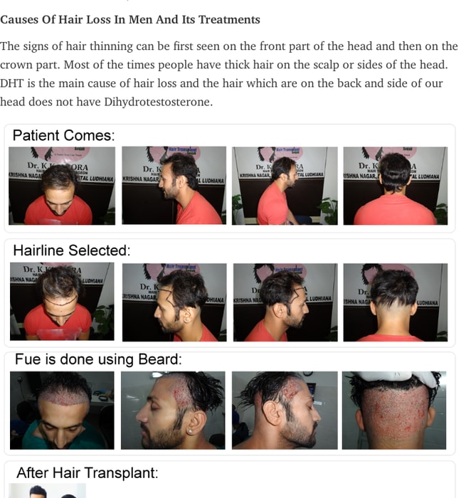 Affordable Hair Transplant in Ludhiana At Satyam Hair Transplant Centre