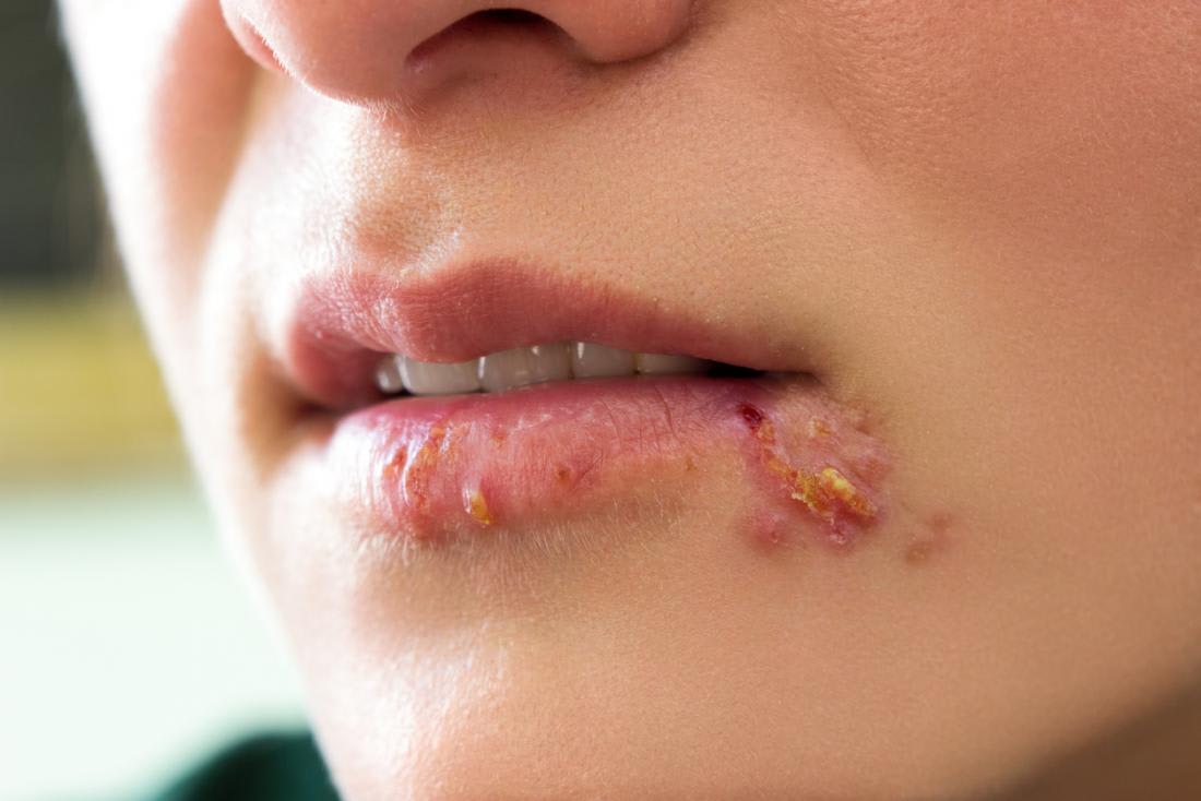 Herpes simplex the most famous virus nowadays Peeker Health