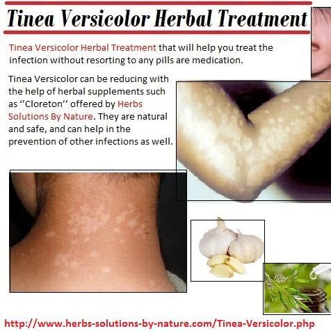 Herbal Treatment of Tinea Versicolor Yeast Infection - Herbs Solutions By Nature