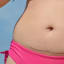 C-Tuck:Tummy Tuck After a C-Section - Dr. Kendall Roehl