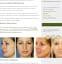 Private Nose Surgery rhinoplasty Liverpool & Manchester