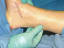 When Consider for Plantar Fascitis Surgery - Your Health Guideline