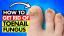 NASTY TOENAIL FUNGUS! How To Get Rid of It Now!