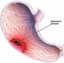 Stomach Cancer Symptoms, Causes, Diagnosis and Treatment - Natural Health News