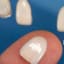How Porcelain Dental Veneers can Help Repair Chipped, Broken and Unsightly Teeth?