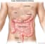 UH Digestive health convention alterations Colorectal cancer Screening
