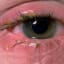 Is it good to treat conjunctivitis with chamomile?