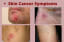 What are The Different Types of Skin Cancer Symptoms