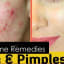 5 Effective Home Made Remedies For Acne and Pimples