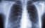 Chest X-rays miss nearly quarter of lung cancers, review finds