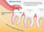 Wisdom Tooth Extraction in Barsha - All Smiles Dental Spa, Dubai