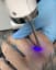 Laser Tattoo Removal!