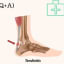 Achilles Tendon Injury, causes symptoms and treatments ( Q+A )