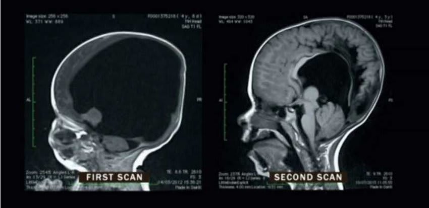 These are MRI scans of a boy born with only 2% of his brain and 2 years later. His brain regrew to 80% of its intended size and he only suffers from comparably small cognitive deficits today