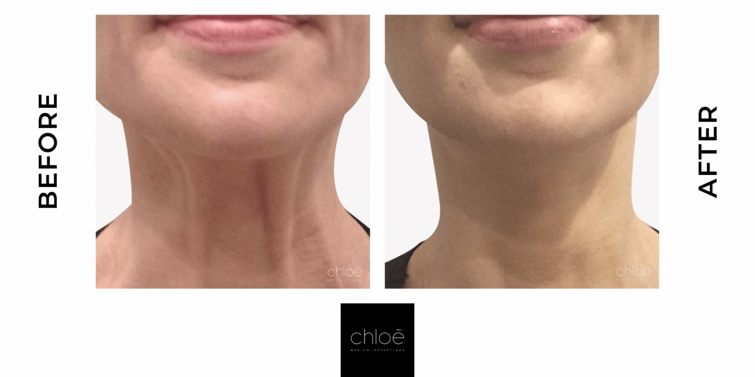 Mix · Non Surgical Neck Lift Botox