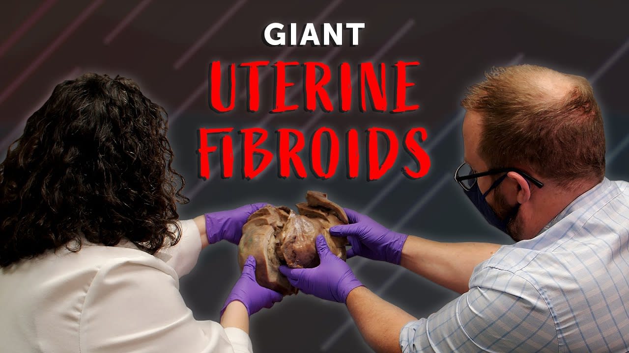 Unboxing Giant Uterine Fibroids