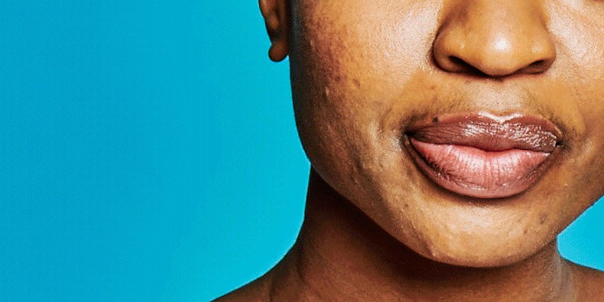 The 11 Best New Skin-Care Products for Oily and Acne-Prone Skin