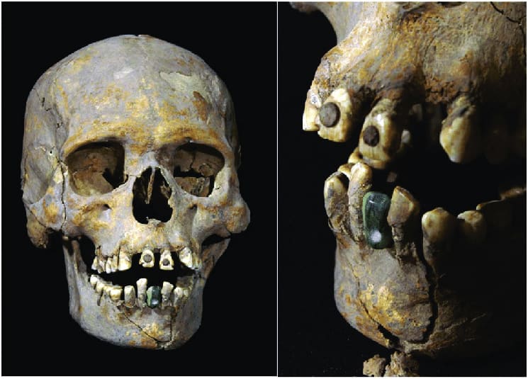 This 1600-year-old Mesoamerican has fancy tooth ornaments! In the picture you can see a serpentinite jadeite prosthetic tooth as well as deliberate pyrite dental modifications. 😁 📷 : Goguitchaichvili et al Journal of Archaeological Science: Reports 2017