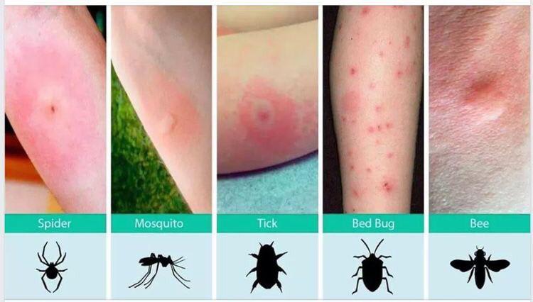 Warning: bug bites. Guide to the different types of common bug bites