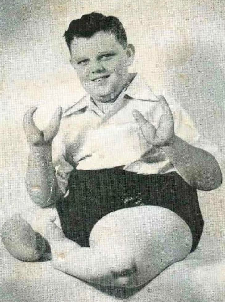 Grady Franklin Stiles Jr. was born with a genetic disability known as ectrodactyly, and he performed in carnivals under the stage name “Lobster Boy”