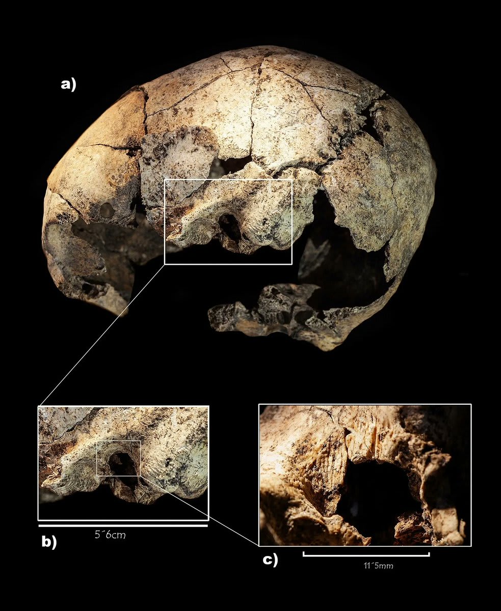 This 6,000 year old skull has evidence of the first known ear surgery... and it would have been absolutely brutal. Read more: https://t.co/lCxWUVc1fS 📷: Navarro et al., Scientific Reports, 2022